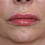 A woman's lips after SILIKON 1000