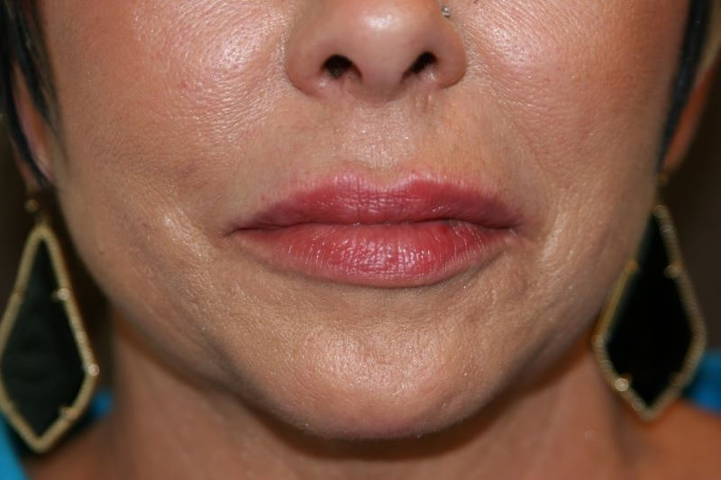 A woman's lips after SILIKON 1000