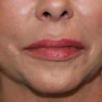 A woman's lips after SILIKON 1000