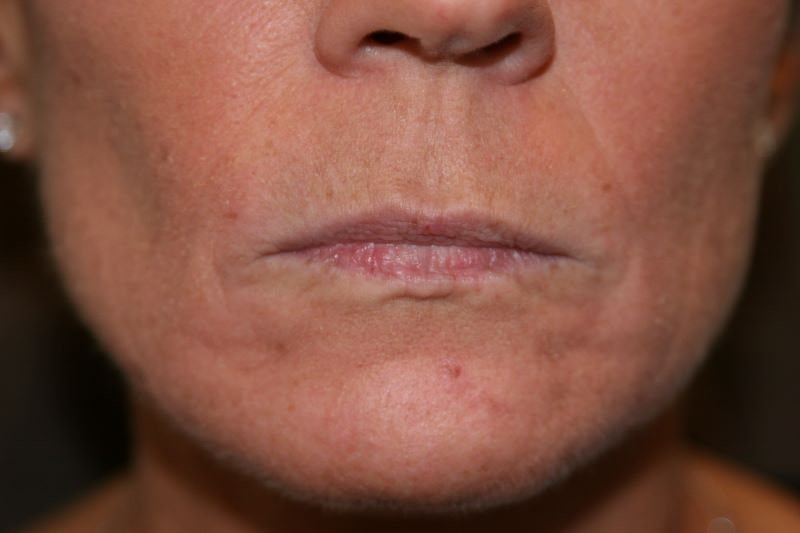 A woman's lips before SILIKON 1000