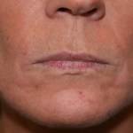 A woman's lips before SILIKON 1000