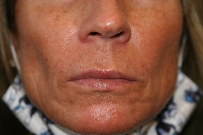 A woman's lips after SILIKON 1000