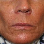 A woman's lips after SILIKON 1000