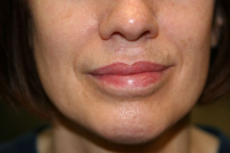 A woman's lips after SILIKON 1000