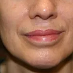 A woman's lips after SILIKON 1000