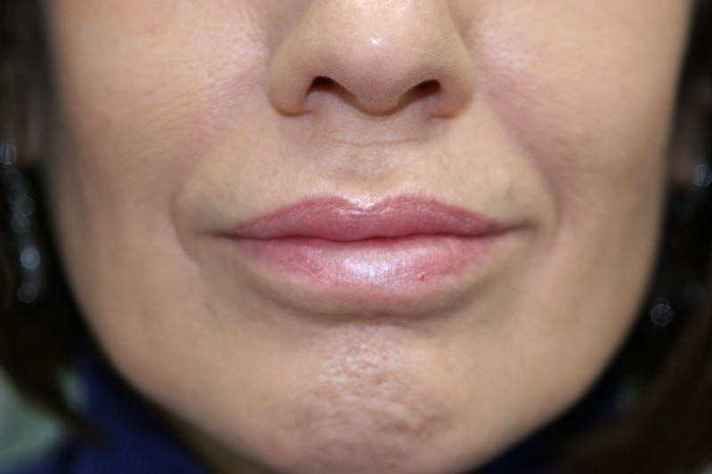 A woman's lips after SILIKON 1000