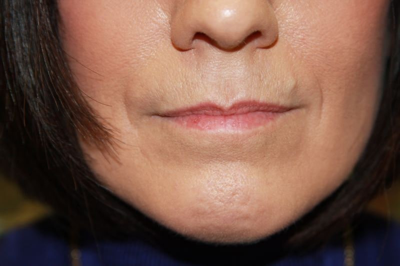A woman's lips before SILIKON 1000