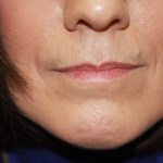 A woman's lips before SILIKON 1000