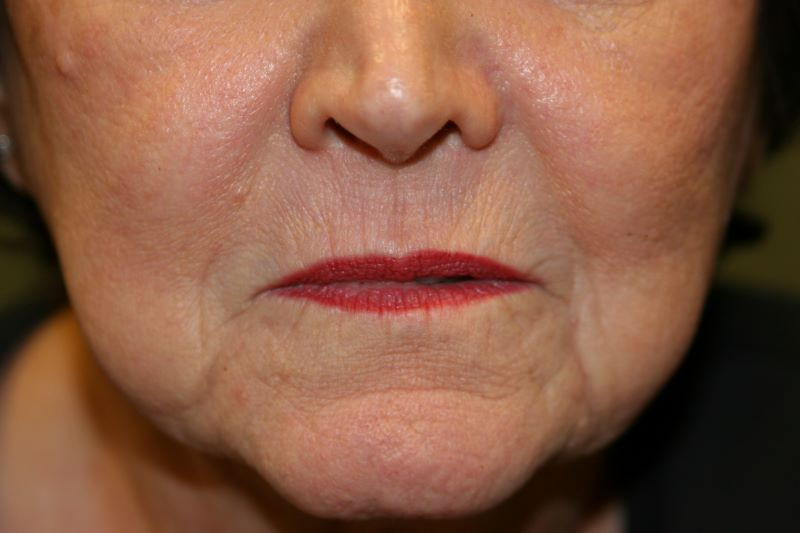 A woman's lips before SILIKON 1000
