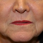 A woman's lips before SILIKON 1000