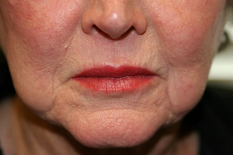 A woman's lips after SILIKON 1000