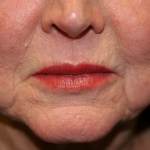 A woman's lips after SILIKON 1000
