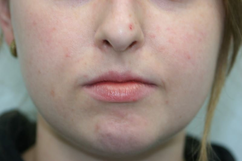 A woman's lips before SILIKON 1000