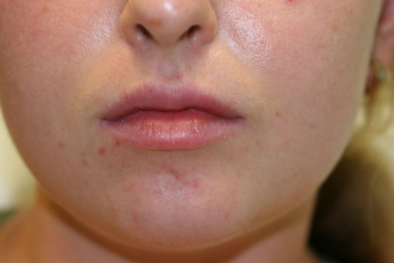 A woman's lips after SILIKON 1000