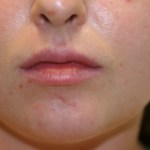 A woman's lips after SILIKON 1000
