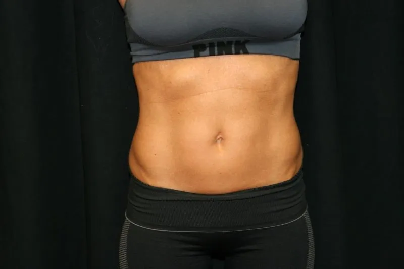 A woman's midriff with less fat after BodyTone