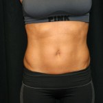 A woman's midriff with less fat after BodyTone