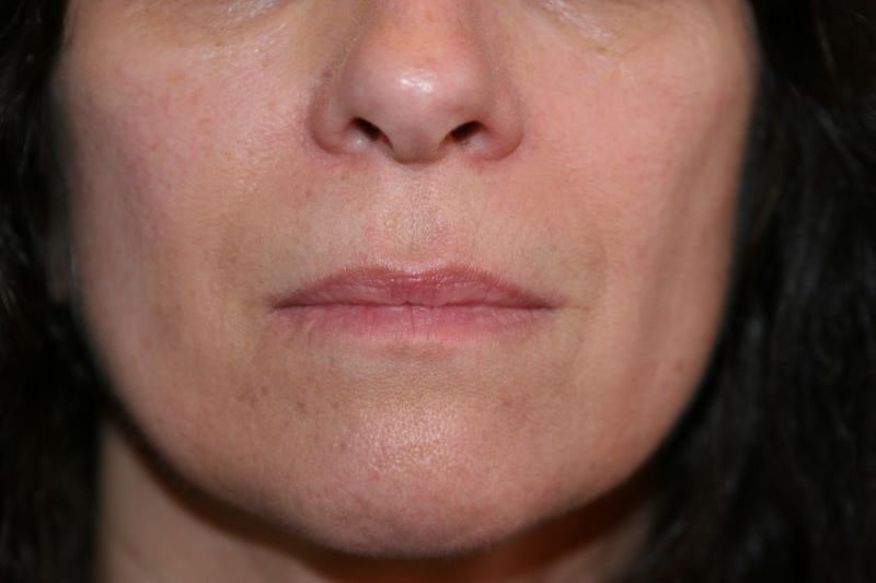 A woman's lips before SILIKON 1000