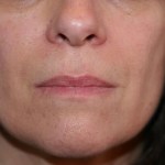 A woman's lips before SILIKON 1000