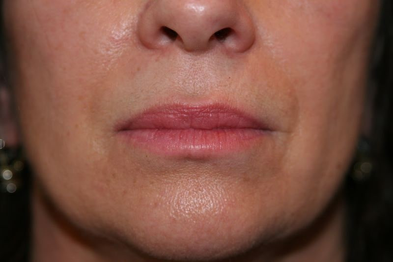 A woman's lips after SILIKON 1000