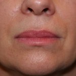 A woman's lips after SILIKON 1000