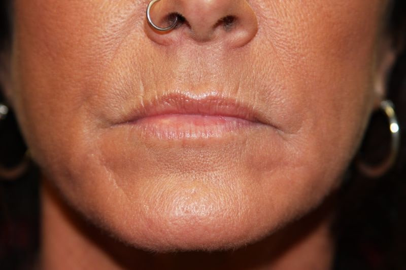 A woman's lips before SILIKON 1000