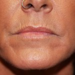 A woman's lips before SILIKON 1000