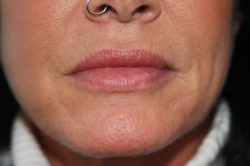 A woman's lips after SILIKON 1000