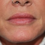 A woman's lips after SILIKON 1000