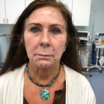 A woman's face before threadlifts