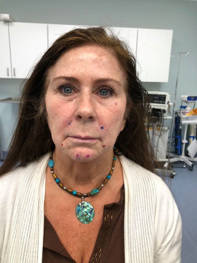 A woman's face before threadlifts