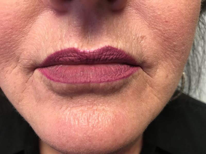 A woman's lips after SILIKON 1000