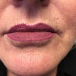 A woman's lips after SILIKON 1000
