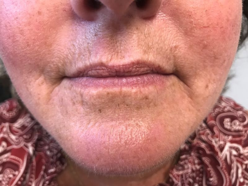 A woman's lips before SILIKON 1000
