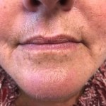 A woman's lips before SILIKON 1000