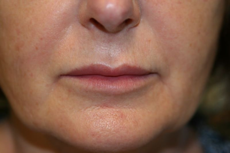 A woman's lips after SILIKON 1000