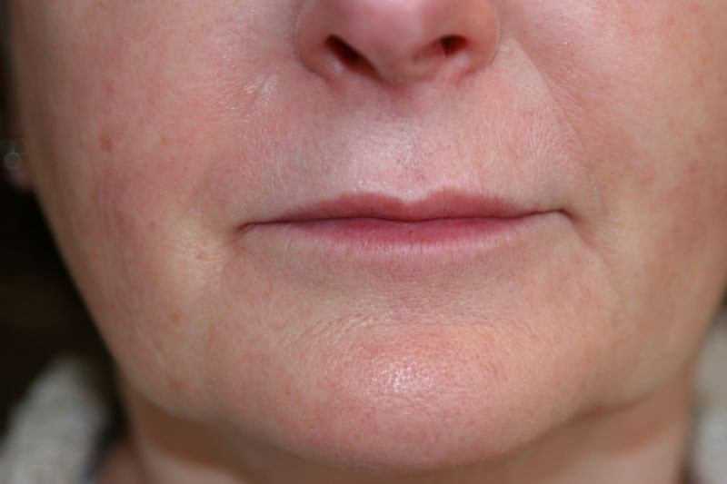 A woman's lips before SILIKON 1000