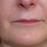 A woman's lips before SILIKON 1000