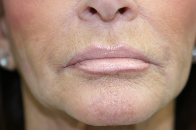 A woman's lips after SILIKON 1000