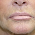 A woman's lips after SILIKON 1000