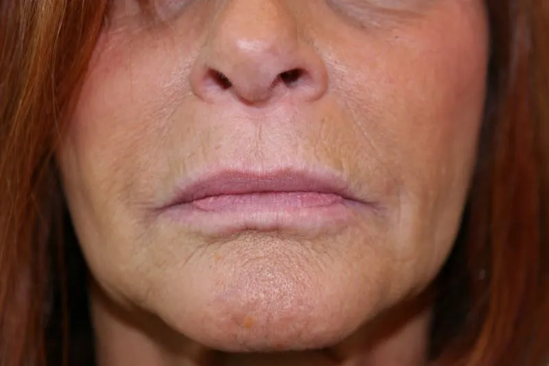A woman's lips after SILIKON 1000