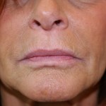 A woman's lips after SILIKON 1000