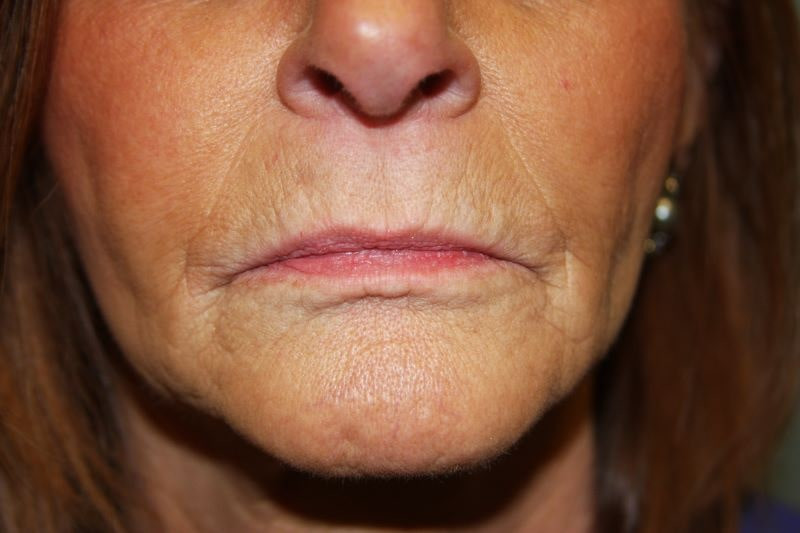 A woman's lips before SILIKON 1000