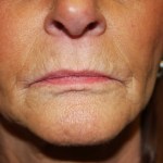 A woman's lips before SILIKON 1000