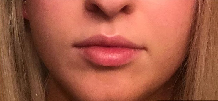 A woman's lips after SILIKON 1000