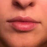 A woman's lips after SILIKON 1000