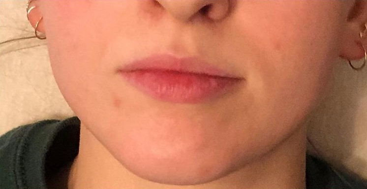 A woman's lips before SILIKON 1000