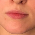 A woman's lips before SILIKON 1000