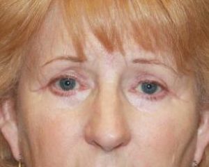 After 4 Lid Eyelid Lift