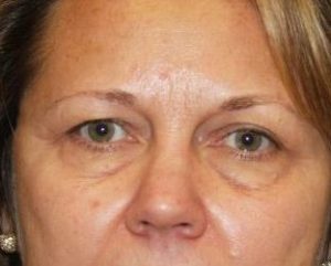 Before 4 Lid Eyelid Lift